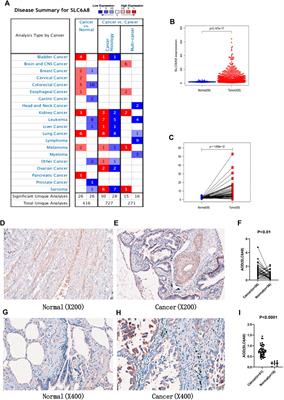 SLC6A8 is a Potential Biomarker for Poor Prognosis in Lung Adenocarcinoma